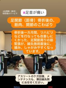 「距骨骨折後に足首のこわばりが残る患者が鍼灸施術を受け、しゃがみ込みが改善した様子」