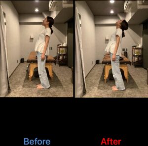 体幹を反る動作のBefore/After比較。施術後は胸郭が開き、体幹伸展の関節可動域が広がり、背部痛が軽減。