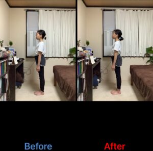 立位側面のBefore/After比較。施術後は体幹の安定性が増し、姿勢ラインが整っている。