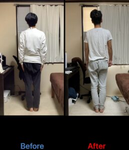 20代男性のパニック障害症例。鍼灸治療の継続で猫背気味の背面姿勢が自然な直立へ変化し、重心・肩甲帯・骨盤のバランスが改善したBefore/After写真。