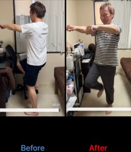 「50代男性メニエール病、鍼灸施術で首痛・めまいが改善。足踏み検査50歩の回転角度が110°から40°へ改善した様子」