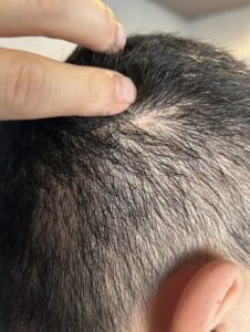 円形脱毛症に対する鍼灸施術開始から約8か月後の頭頂部と側頭部の最新状態
