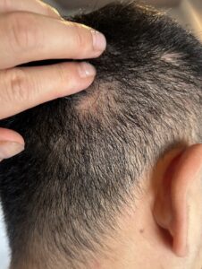 円形脱毛症の施術開始から約8か月後に毛髪を指で分けて発毛部を確認した写真